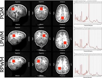 A Neurometabolic Pattern of Elevated Myo-Inositol in Children Who Are HIV-Exposed and Uninfected: A South African Birth Cohort Study